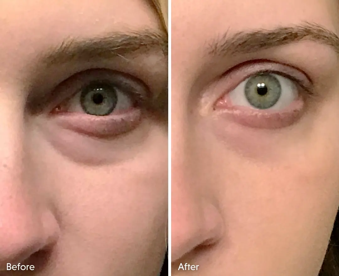 Testimonio Parches de hidrogel Eye-V® Moisture Boost